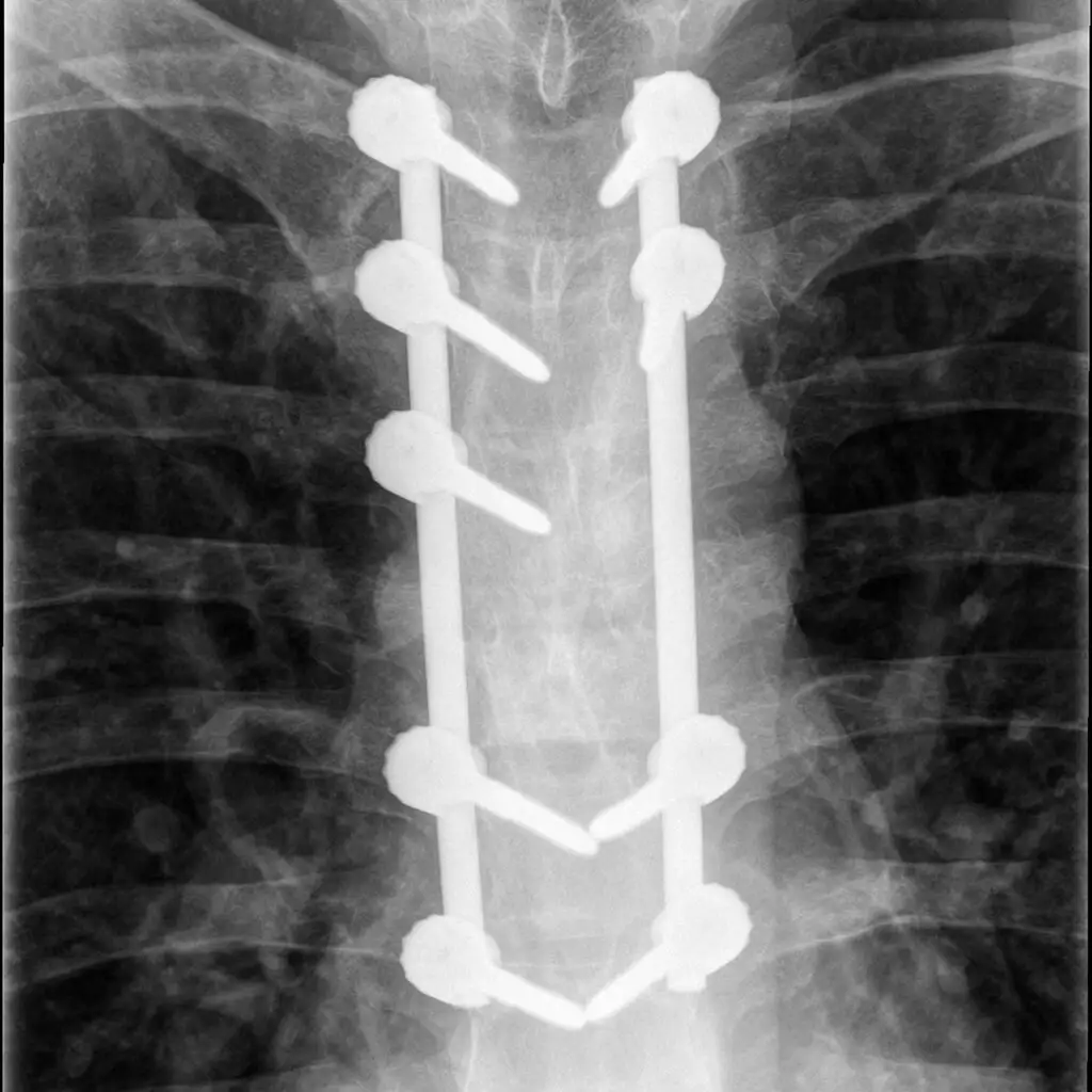 Polytrauma - series of pencil drawings in sketch book - x-ray of post operative vertebra fractures