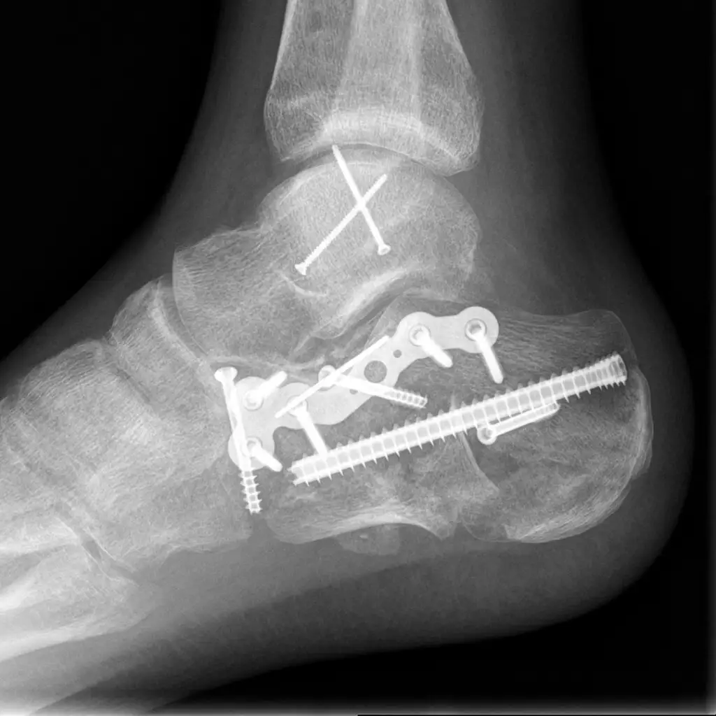 Polytrauma - series of pencil drawings in sketch book - x-ray of a post operative heel bone fracture